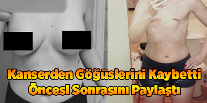 Kanserden Göğüslerini Kaybetti Öncesi Sonrasını Paylaştı