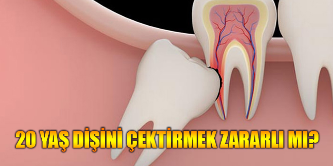 20 yaş dişini çektirmek zararlı mı ?