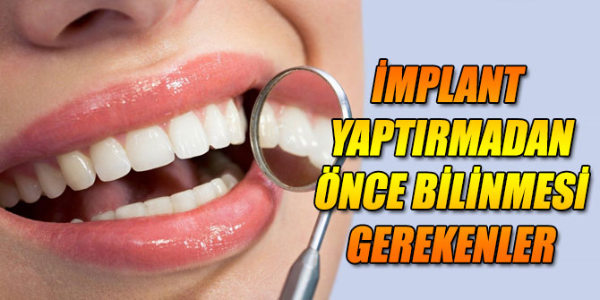 İmplant tedavisini yaptırmadan önce bilinmesi gerekenler