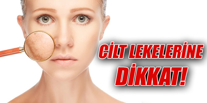 Cilt lekelerine dikkat