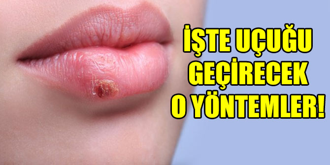 İşte uçuğu geçirecek o yöntemler!