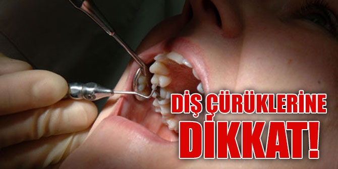 Uzmanlar diş çürüklerine dikkat edilmesi konusunda uyardı