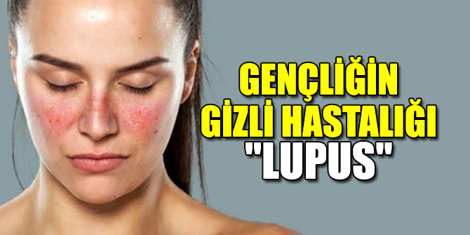 Gençliğin Gizli Hastalığı "​LUPUS"