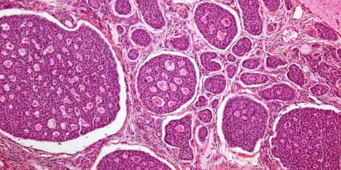 Kemoterapisiz kanser tedavisi dönemi