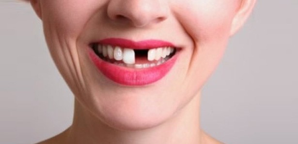 Diş eksikliği özgüveni olumsuz etkiliyor