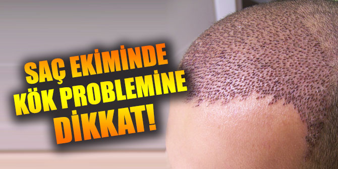 Saç ekiminde kök problemine dikkat edilmeli
