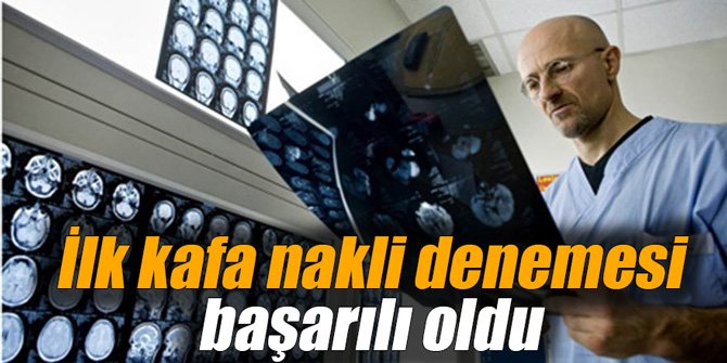 İlk kafa nakli denemesi başarılı oldu