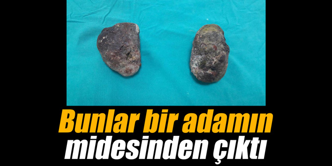 Bunlar bir adamın midesinden çıktı