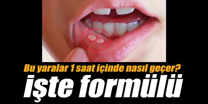 Bu yaralar 1 saat içinde nasıl geçer? İşte formülü
