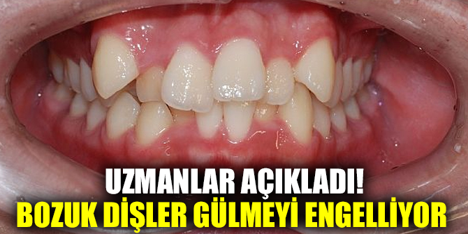 Uzmanlar açıkladı! Bozuk dişler gülmeyi engelliyor