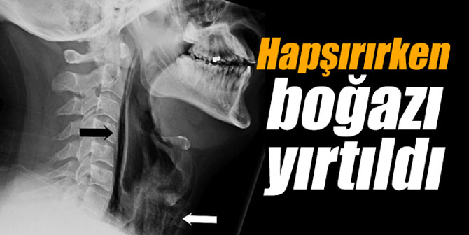 Hapşırırken boğazı yırtıldı