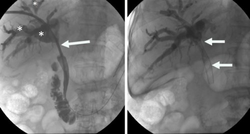 gastroenteroloji-girisimsel-radyolojide-hibrit-yaklasimlar-zorlu-safra-yolu-tedavilerinde-yeni-donem.jpeg