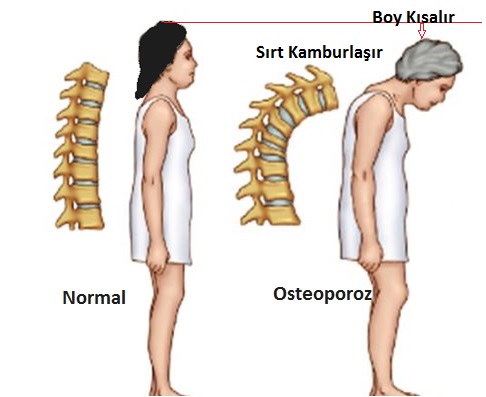 postmenapozal-osteoporoz-2.jpg